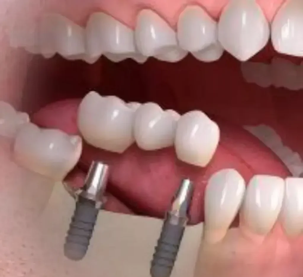 Illustrazione implantologia dentale