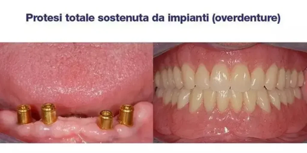Immagine protesi dentale